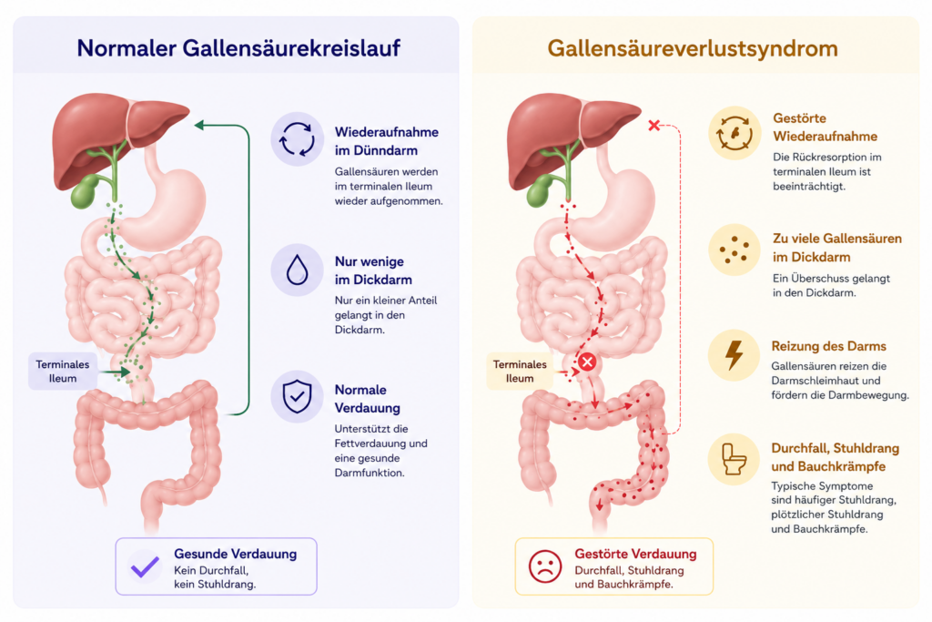 Infografik zum Vergleich zwischen normalem Gallensäurekreislauf und Gallensäureverlustsyndrom mit gestörter Rückresorption im terminalen Ileum, Gallensäuren im Dickdarm sowie Durchfall und Stuhldrang.